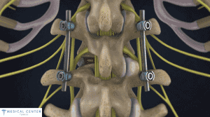 Spinal Fusion Cost in Turkey