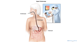 STOMACH CANCER STAGE 2