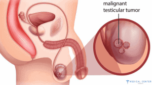 TESTICULAR CANCER IN TURKEY