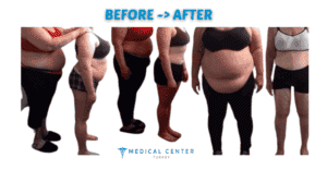 the best and cheapest weight loss surgery by country