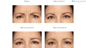 The Latest Advances in Anti-Wrinkle Injections in Turkey 2025