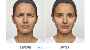 The Latest Advances in Anti-Wrinkle Injections in Turkey 2025