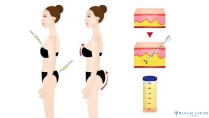 The Role of Fat Transfer in Modern Cosmetic Surgery
