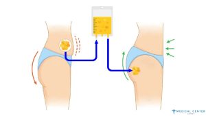 The Role of Fat Transfer in Modern Cosmetic Surgery