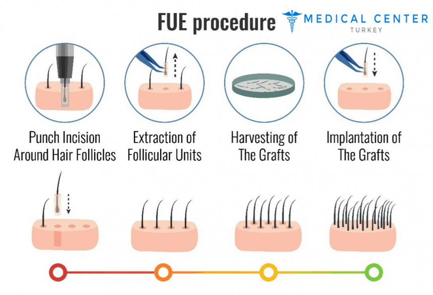 The Ultimate Hair Transplant Guide in Turkey