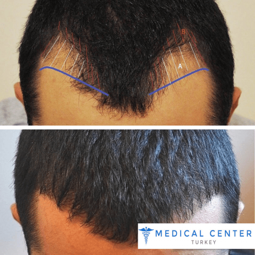 hair_transplant_before_after