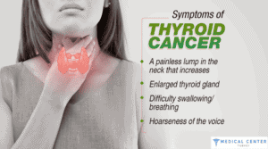 Therapy with Radioactive Iodine in Therapy Cancer