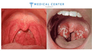 Throat Cancer Operation 