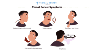 Throat Cancer Operation 