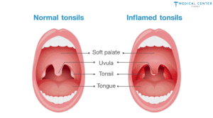 Tonsil Cancer