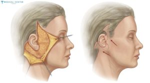 Top 5 Trending Cosmetic Surgeries You Should Know About in 2025