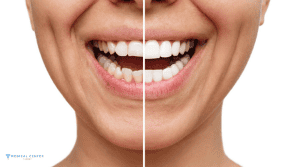 Transform Your Smile With Dent Restoration