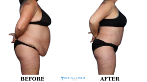 Tummy Tuck Cost 2
