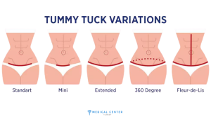 Tummy Tuck Cost 4