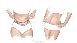Tummy Tuck Cost 9