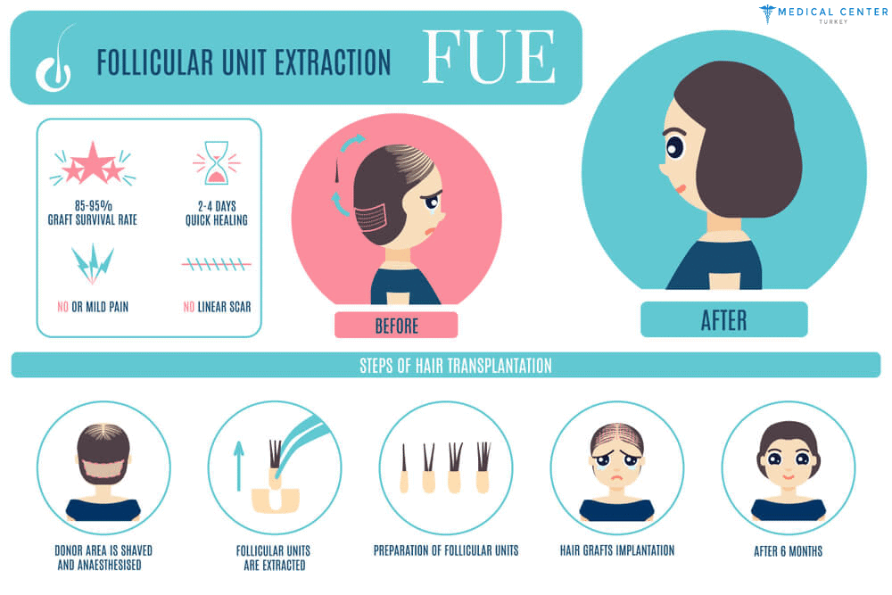 Unshaven and Painless Hair Transplantation