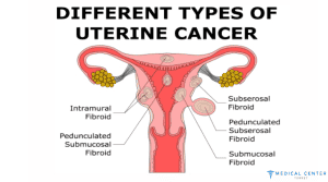 UTERINE CANCER