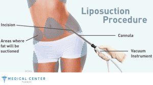 Vaser Liposuction Turkey Before and After
