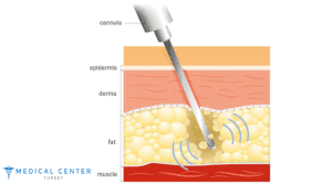 Vaser Liposuction Turkey Before and After