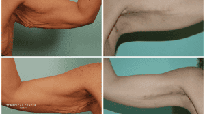 What are the Expected Result of an Arm Lift in Turkey?