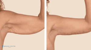 What are the Expected Result of an Arm Lift in Turkey ?