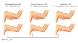 What are the Expected Result of an Arm Lift in Turkey?