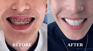What are the Most Popular Aesthetic Procedures in Turkey?