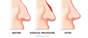 What are the Most Popular Aesthetic Procedures in Turkey?