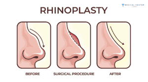 What are the Reasons Why Nose Surgery is Cheap in Turkey?