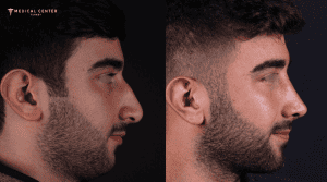 What are the Reasons Why Nose Surgery is Cheap in Turkey?