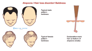 What are the treatment options for baldness