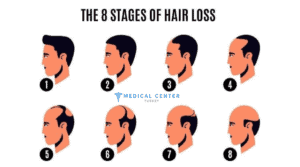 What are the treatment options for baldness
