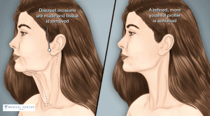 What Change Can Be Expected Before and After Neck Lift?