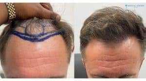 What is New in Hair Transplants in 2026?