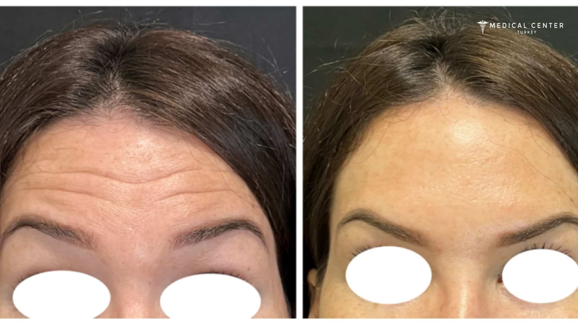 What Results Can Be Expected From Botox?