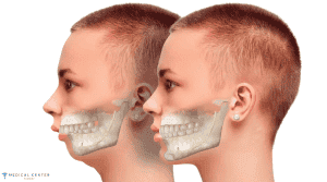What Surgery is Best 5 Types of Jaw Surgery in Turkey 1