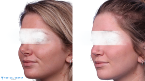 Rhinoplasty Surgery 2