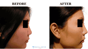 Rhinoplasty Surgery 3