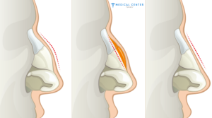 Rhinoplasty Surgery 4