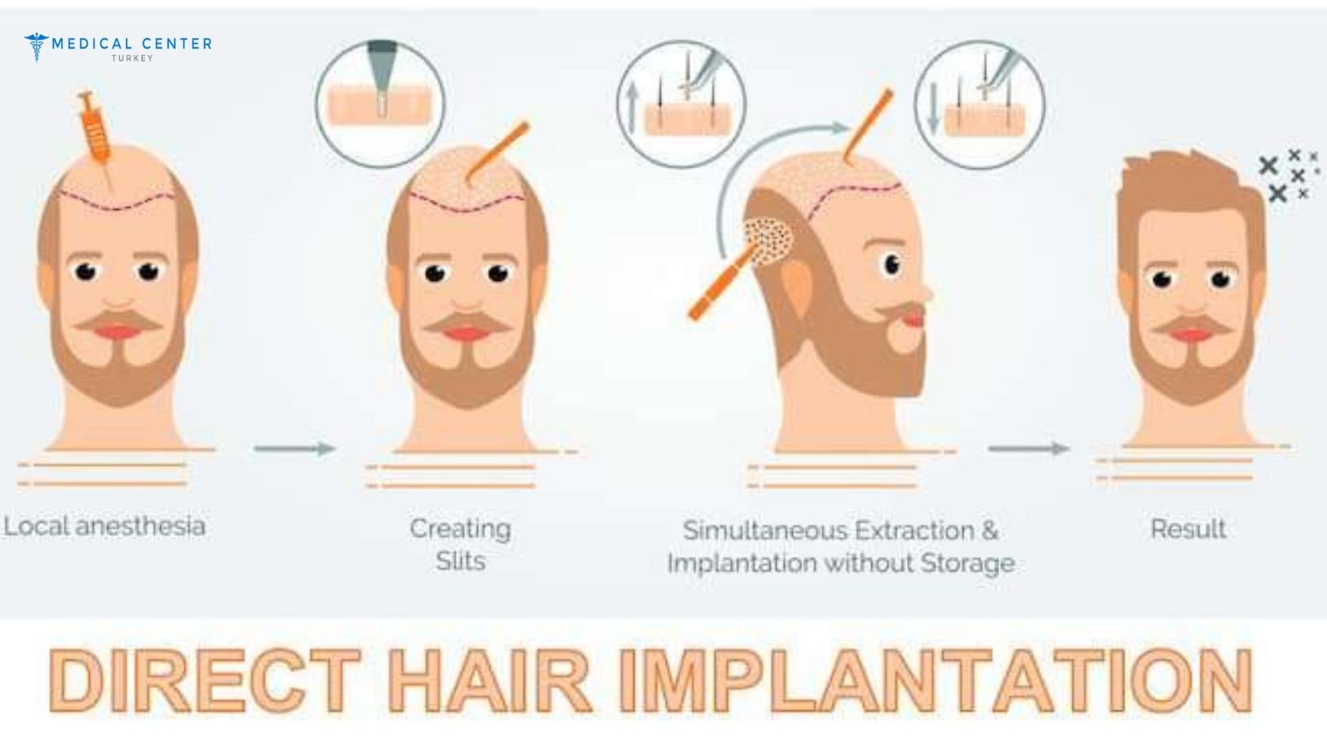 When Will You See Results After a Hair Transplant?