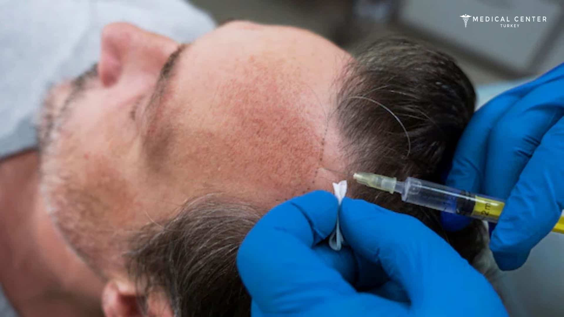 When Will You See Results After a Hair Transplant?