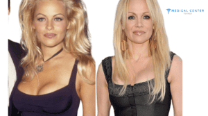 Which Celebrities got Breast Implants?