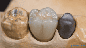 Why Do People Go to Turkey for Dental Treatment?
