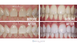 Why Do People Go to Turkey for Dental Treatment?