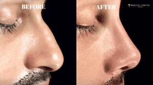 Why is 2026 the Best Year to Get a Nose Job?
