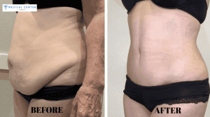 Why is Everyone Talking About Liposuction in Turkey?