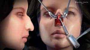 Why Is Preservation Rhinoplasty So Popular in 2026?