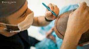 Why Does Turkey Still Delivers Top Results in Hair Transplants?
