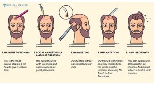 Why Does Turkey Still Delivers Top Results in Hair Transplants?