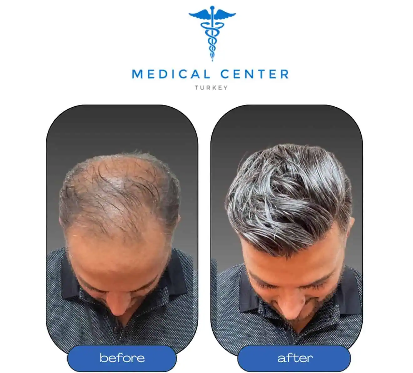 Hair transplant before and after Turkey — FUE result patient 1